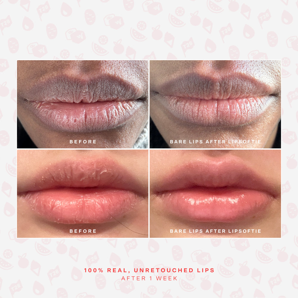 LipSoftie® Lip Treatment